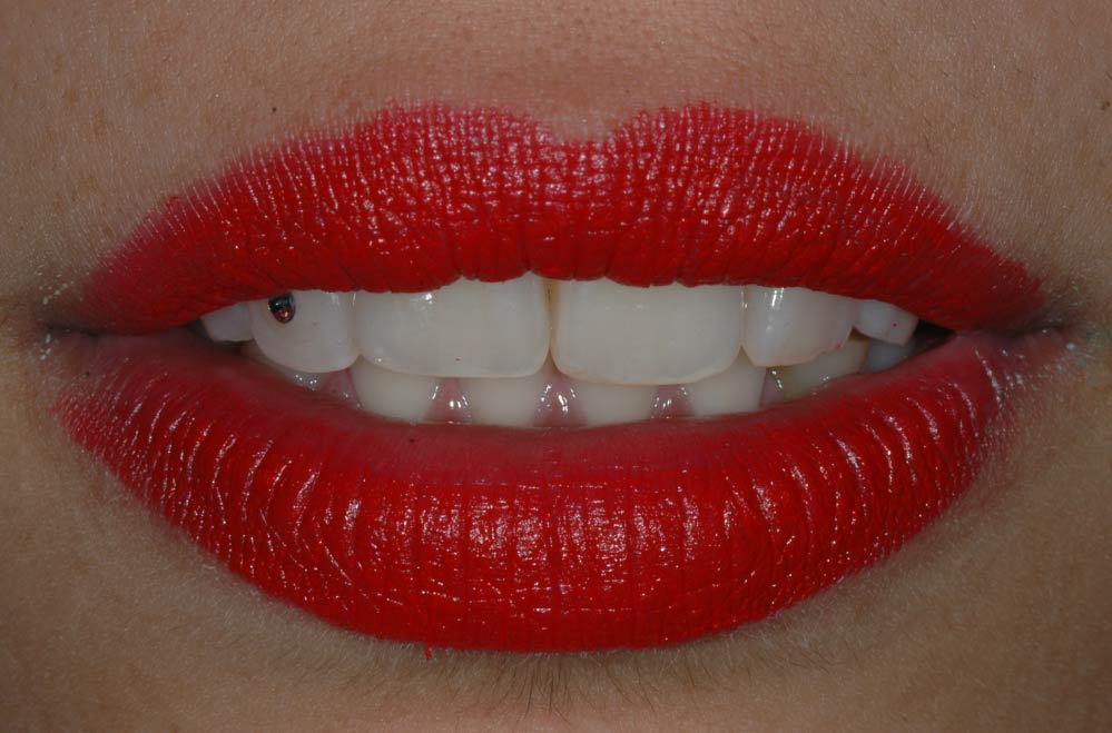 Estetica dentale - Brillantino sul dente 03 - Studio Pelagalli - Centro Odontoiatrico Roma