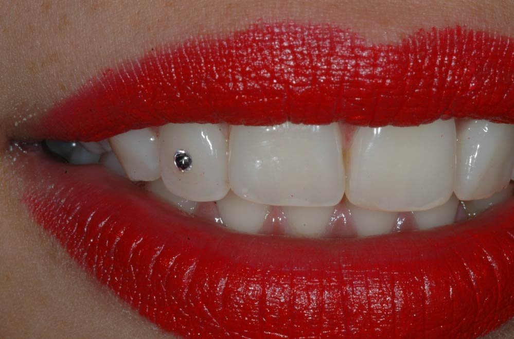 Estetica dentale - Brillantino sul dente 04 - Studio Pelagalli - Centro Odontoiatrico Roma