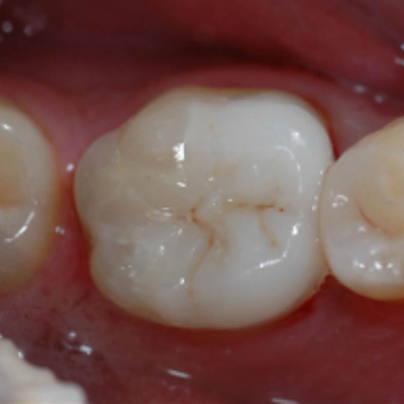 Estetica dentale - Intarsi in ceramica 02 - Studio Pelagalli - Centro Odontoiatrico Roma