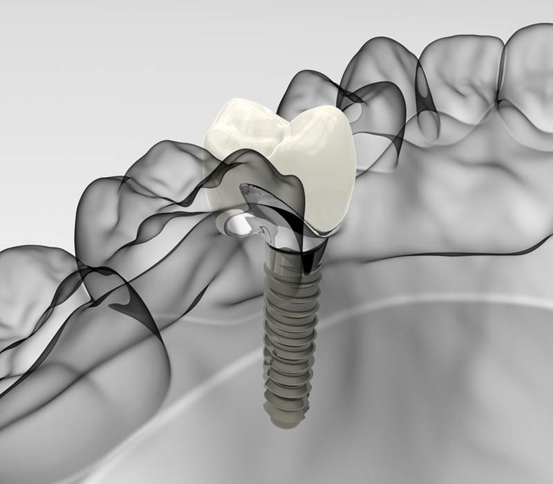 Gli impianti dentali sono piccole viti in titanio utilizzate come radici artificiali in sostituzione delle radici - Studio Pelagalli - Centro Odontoiatrico Roma