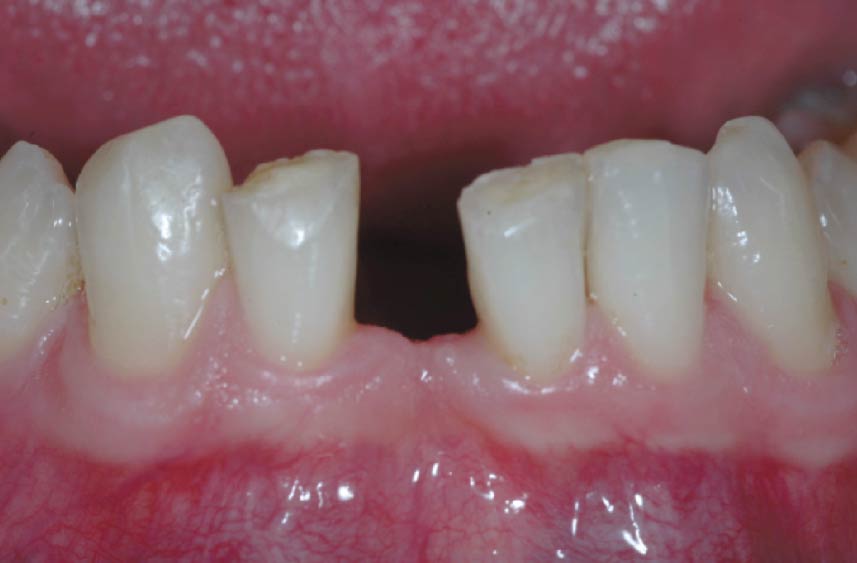 Impianti dentali - 01 - Incisivo inferiore di destra mancante - Studio Pelagalli - Centro Odontoiatrico Roma