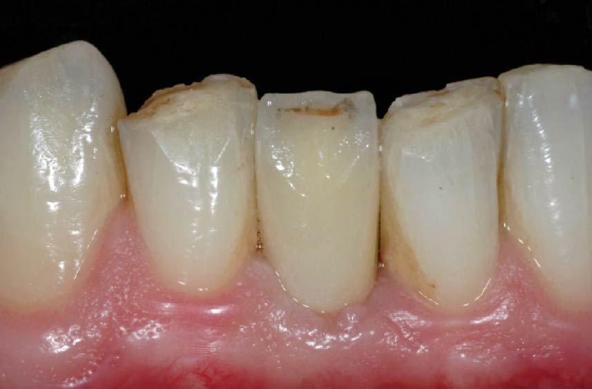 Impianti dentali - 03 - Paziente 6 mesi dopo la protesizzazione definitiva - Studio Pelagalli - Centro Odontoiatrico Roma