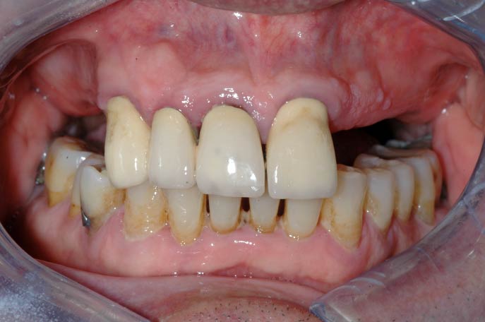 Estetica dentale - Brillantino sul dente 01 - Studio Pelagalli - Centro Odontoiatrico Roma