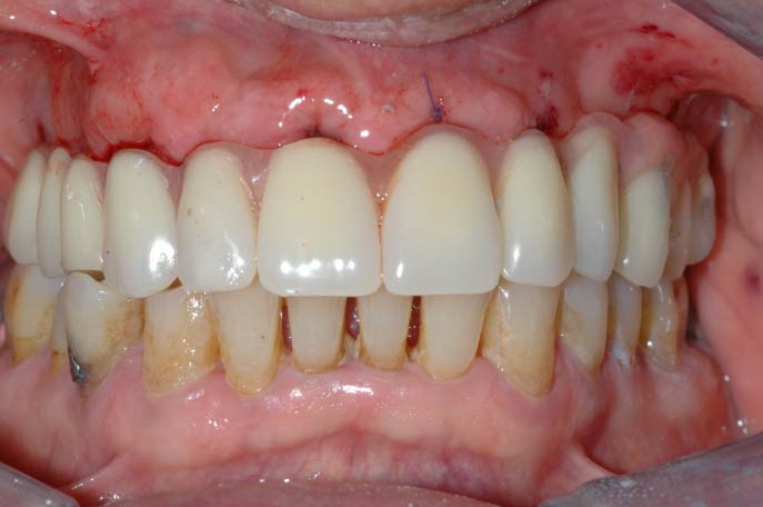 Estetica dentale - Brillantino sul dente 02 - Studio Pelagalli - Centro Odontoiatrico Roma