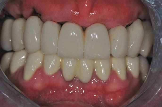 Impianti dentali - Carico immediato - Paziente 2 foto con il provvisorio dopo 8 ore dall'intervento - Studio Pelagalli - Centro Odontoiatrico Roma