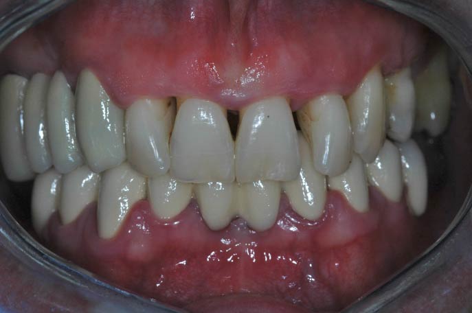 Impianti dentali - Carico immediato - Paziente 2 foto pre-intervento - Studio Pelagalli - Centro Odontoiatrico Roma