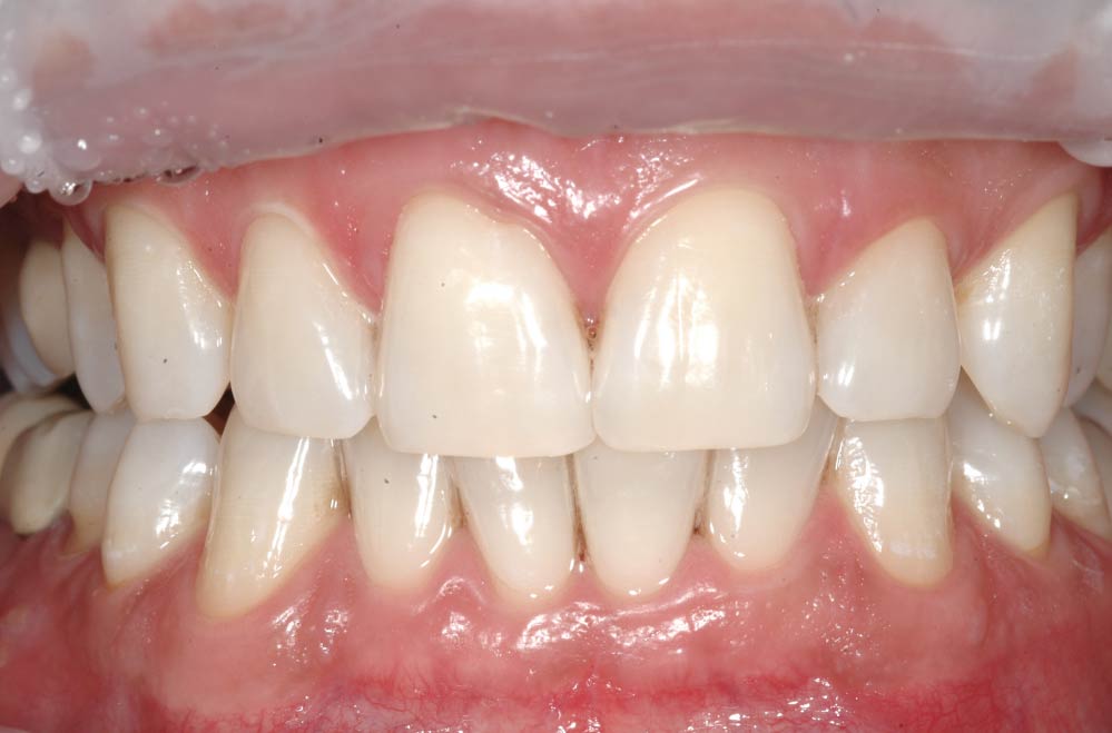 Sbiancamento dentale - Paziente1 - Dopo - Studio Pelagalli - Centro Odontoiatrico Roma