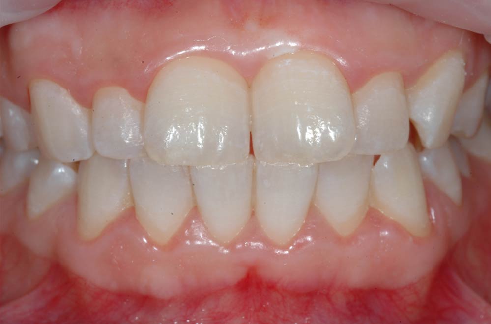 Sbiancamento dentale - Paziente2 - Dopo - Studio Pelagalli - Centro Odontoiatrico Roma