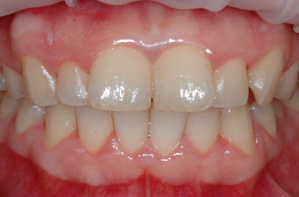Sbiancamento dentale - Paziente2 - Prima - Studio Pelagalli - Centro Odontoiatrico Roma