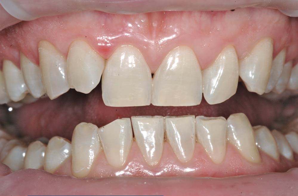 Sbiancamento dentale - Paziente3 - Dopo - Studio Pelagalli - Centro Odontoiatrico Roma