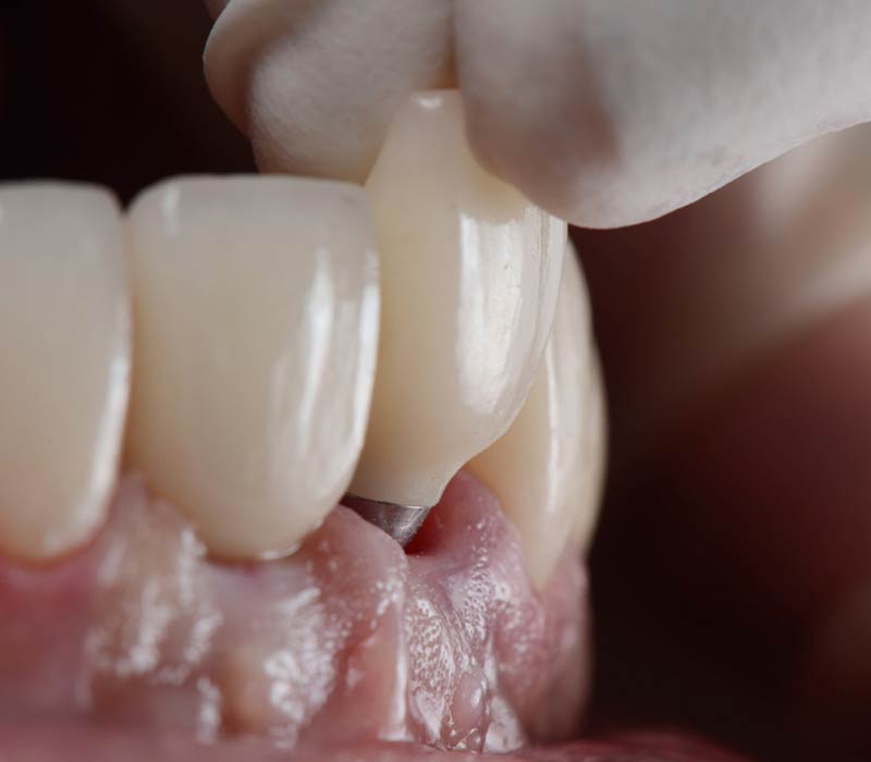 Alta tecnologia dei materiali - impianti dentali - Studio Pelagalli - Centro Odontoiatrico Roma